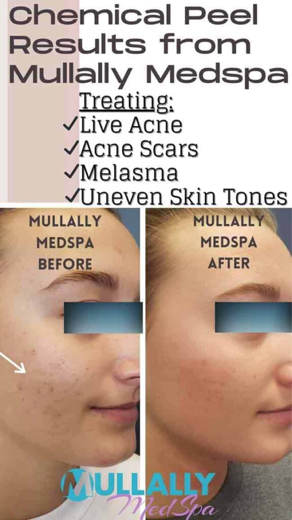 Age Spots Brown or Red Spots (Lumecca Treatment) in Crown Point IN