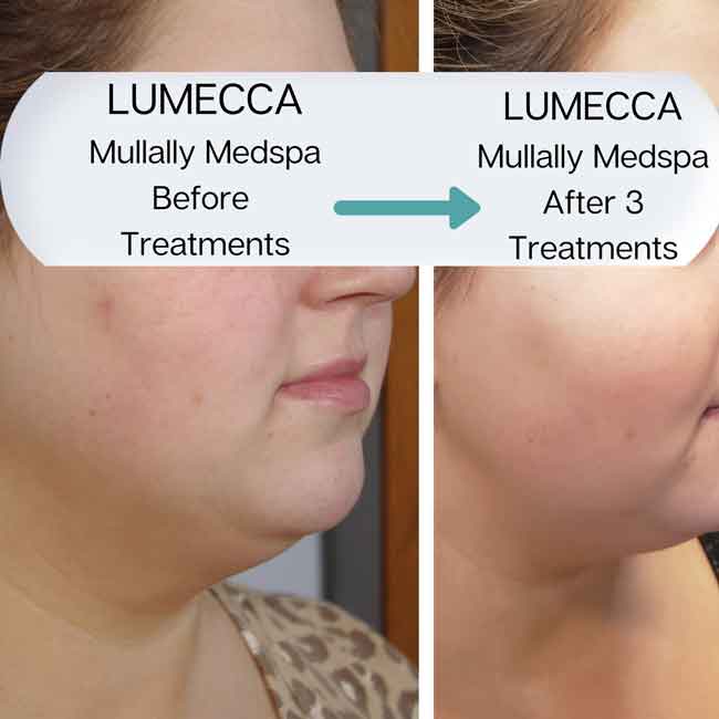 Age Spots Brown or Red Spots (Lumecca Treatment) in Crown Point IN