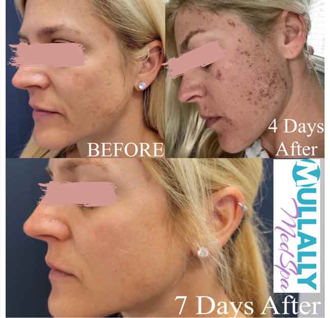 Age Spots Brown or Red Spots (Lumecca Treatment) in Crown Point IN