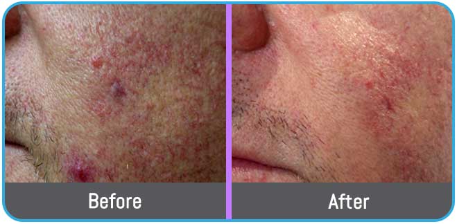 Age Spots Brown or Red Spots (Lumecca Treatment) in Crown Point IN