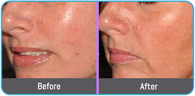 Age Spots Brown or Red Spots (Lumecca Treatment) in Crown Point IN