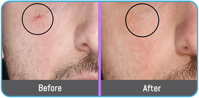 Age Spots Brown or Red Spots (Lumecca Treatment) in Crown Point IN