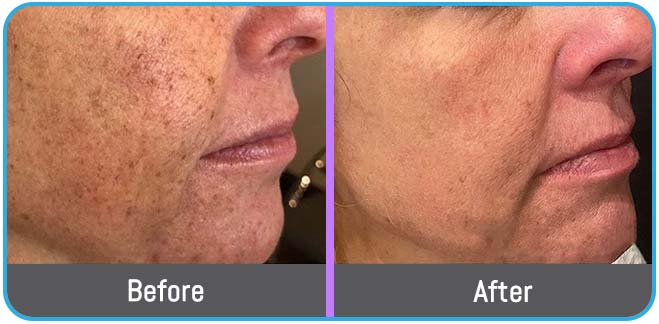 Age Spots Brown or Red Spots (Lumecca Treatment) in Crown Point IN