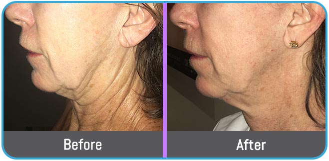 Scarring Stretch Mark and Wrinkles (Morpheus 8 Treatment) in Crown Point IN