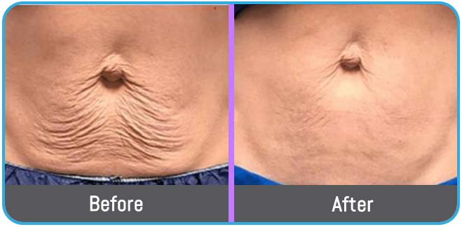 Scarring Stretch Mark and Wrinkles (Morpheus 8 Treatment) in Crown Point IN