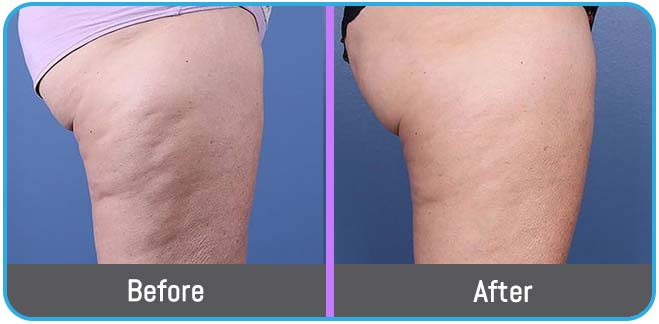 Scarring Stretch Mark and Wrinkles (Morpheus 8 Treatment) in Crown Point IN