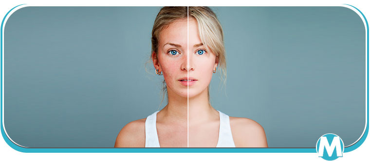 Age Spots, Brown or Red Spots Treatment Specialist Near Me in Crown Point IN Age Spots, Brown or Red Spots Treatment Specialist Near Me in Crown Point IN