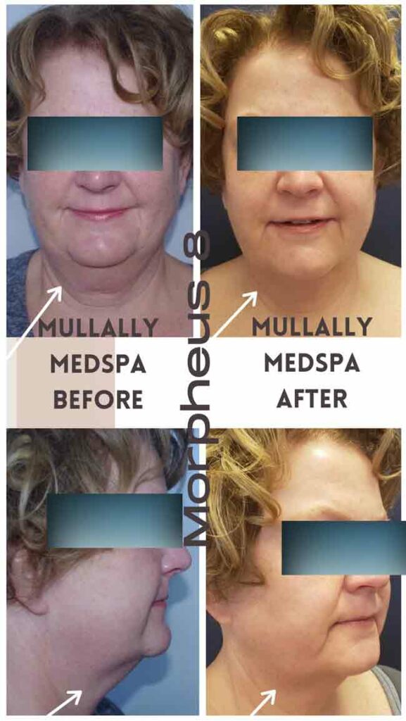 Body Contouring and Skin Tightening (Forma Treatment) in Crown Point IN Body Contouring and Skin Tightening (Forma Treatment) in Crown Point IN