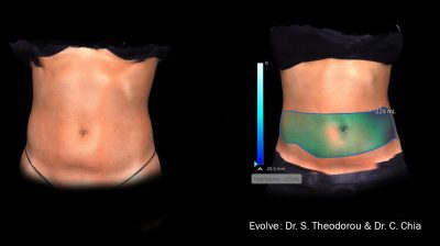 Evolve Skin Tightening Treatment Specialist Near Me in Crown Point IN