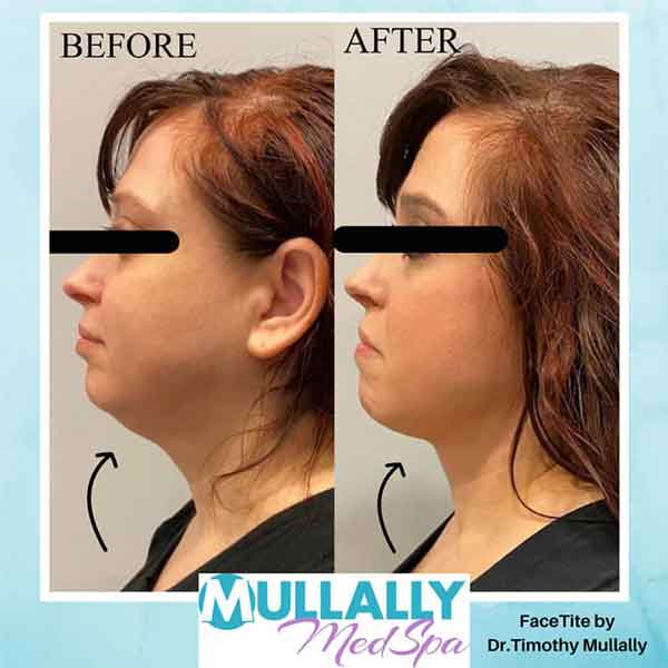 FaceTite Treatment FaceTite Treatment