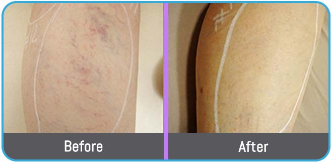 Spider Vein (Vasculaze Treatment) in Crown Point IN