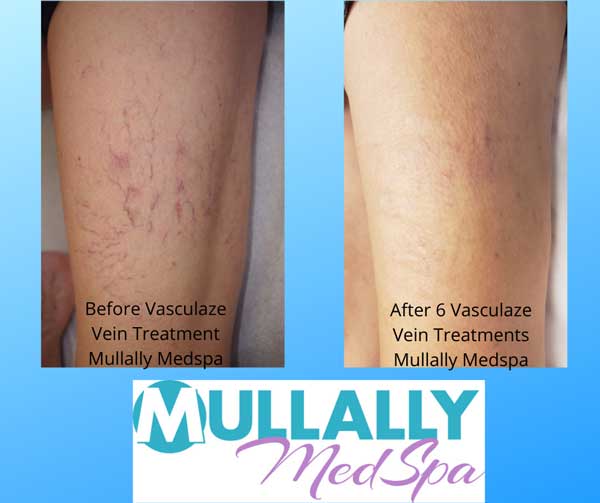 Spider Vein (Vasculaze Treatment) in Crown Point IN