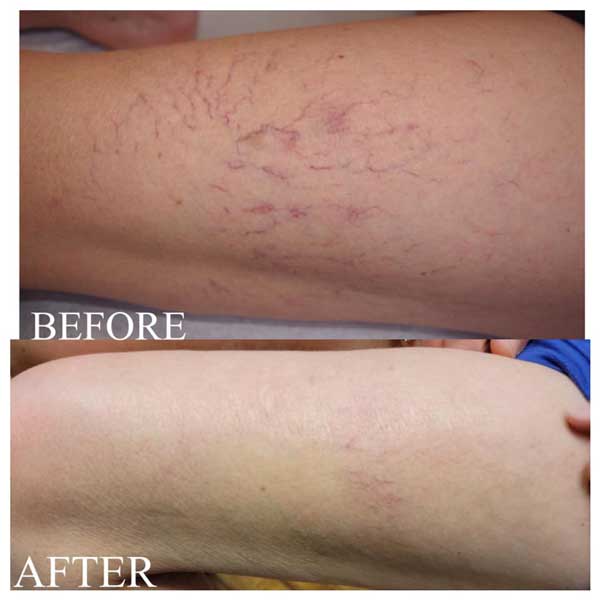 Spider Vein (Vasculaze Treatment) in Crown Point IN