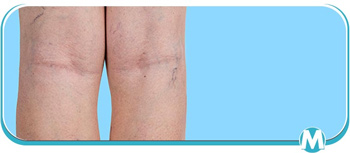 Spider Vein Treatment Specialist Near Me in Crown Point IN Spider Vein Treatment Specialist Near Me in Crown Point IN