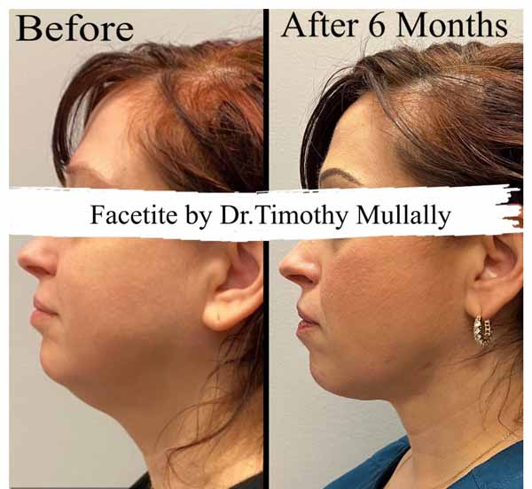 FaceTite Treatment in Crown Point IN