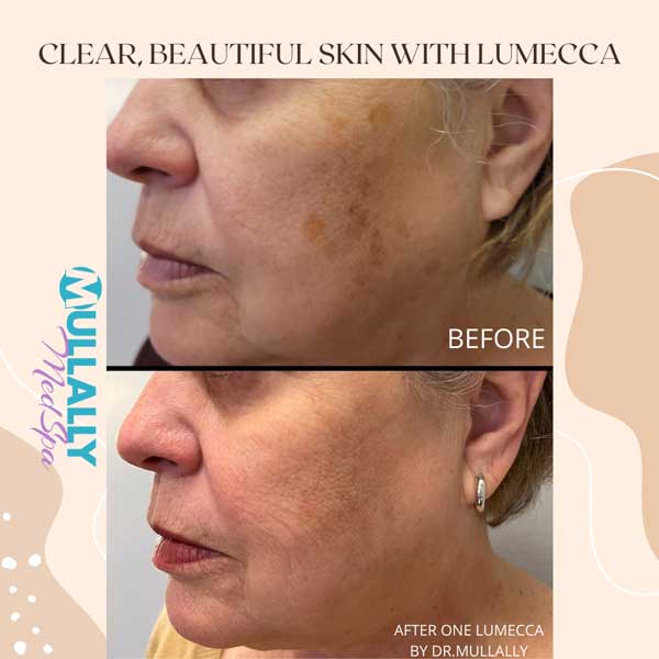 Age Spots Brown or Red Spots (Lumecca Treatment) in Crown Point IN Age Spots Brown or Red Spots (Lumecca Treatment) in Crown Point IN
