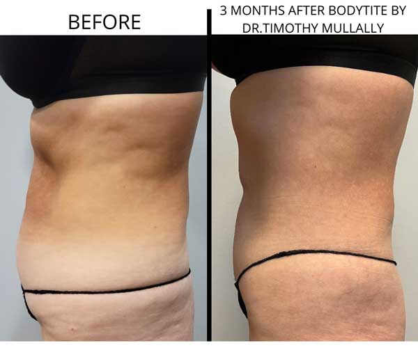 BodyTite Treatment in Crown Point IN