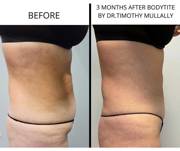 BodyTite Treatment in Crown Point IN