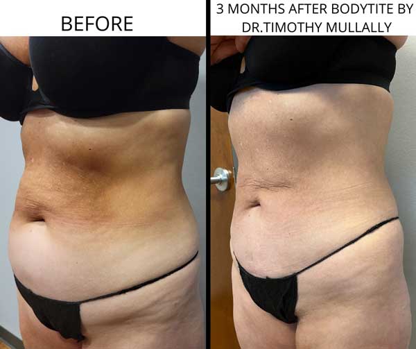 BodyTite Treatment in Crown Point IN