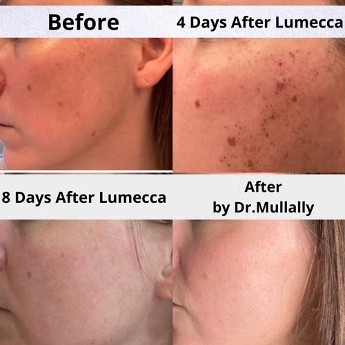 Age Spots Brown or Red Spots (Lumecca Treatment) in Crown Point IN