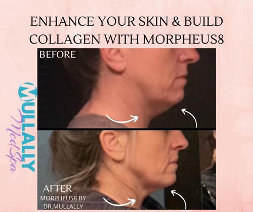 Scarring Stretch Mark and Wrinkles (Morpheus 8 Treatment) in Crown Point IN Scarring Stretch Mark and Wrinkles (Morpheus 8 Treatment) in Crown Point IN