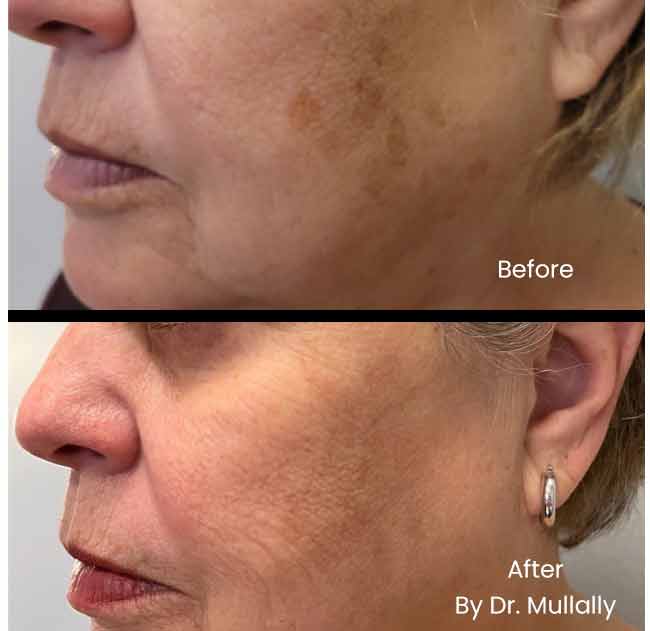 Age Spots Brown or Red Spots (Lumecca Treatment) in Crown Point IN