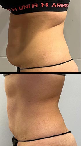 BodyTite Treatment in Crown Point IN