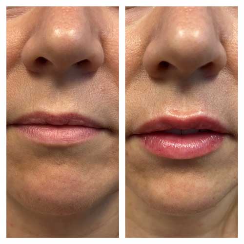 Lip filler Juvederm Treatment in Crown Point IN