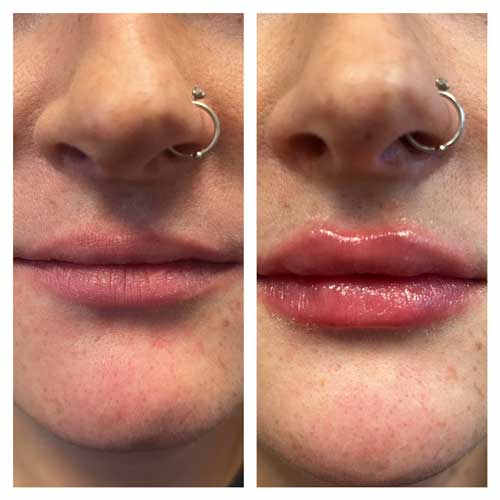 Lip filler Juvederm Treatment in Crown Point IN