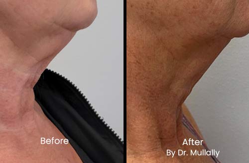 Scarring Stretch Mark and Wrinkles (Morpheus 8 Treatment) in Crown Point IN