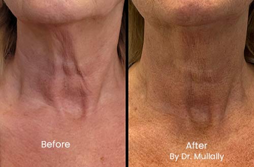 Scarring Stretch Mark and Wrinkles (Morpheus 8 Treatment) in Crown Point IN