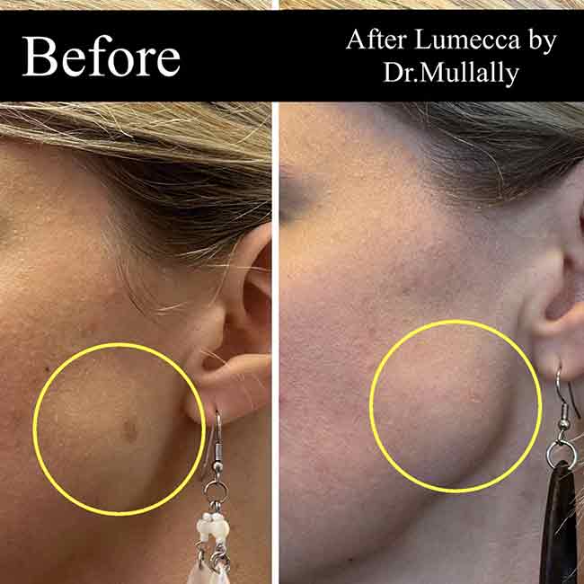 Age Spots Brown or Red Spots (Lumecca Treatment) in Crown Point IN