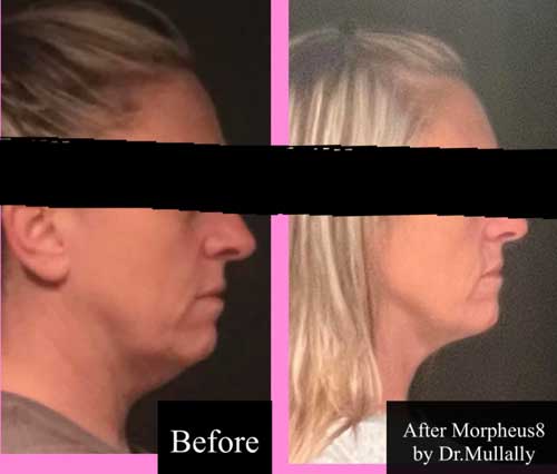 Scarring Stretch Mark and Wrinkles (Morpheus 8 Treatment) in Crown Point IN