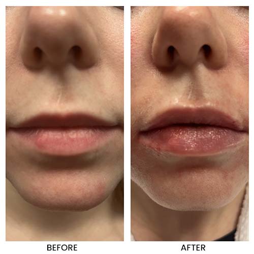 Lip filler Juvederm Treatment in Crown Point IN