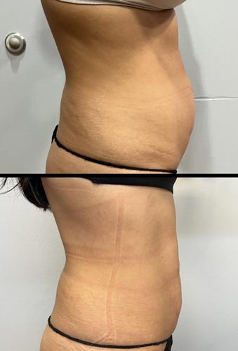 BodyTite Treatment in Crown Point IN