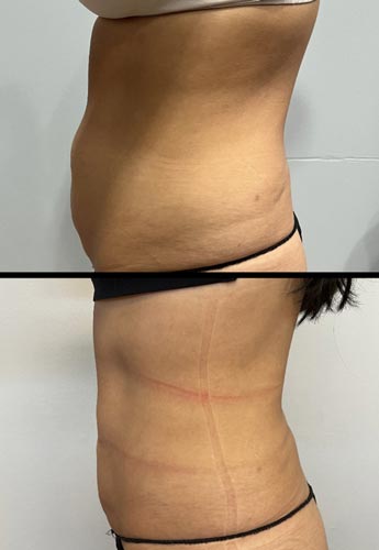 BodyTite Treatment in Crown Point IN