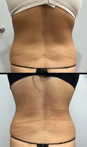 BodyTite Treatment in Crown Point IN