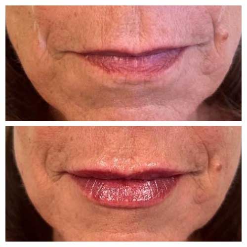 Lip filler Juvederm Treatment in Crown Point IN