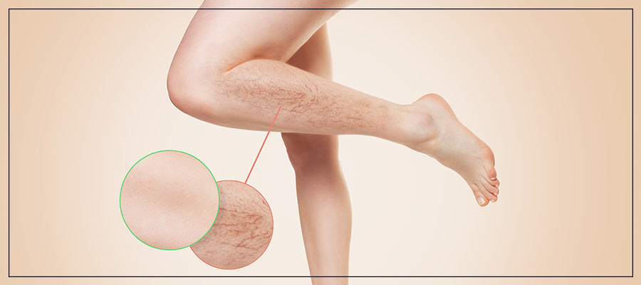 Spider Vein Treatment Specialist Near Me in Crown Point IN Spider Vein Treatment Specialist Near Me in Crown Point IN