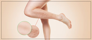 Spider Veins A Full Guide in 2023 - MD SPA