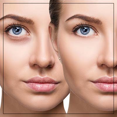 PRP Treatment for Under Eyes Near Me in Crown Point, IN PRP Treatment for Under Eyes Near Me in Crown Point, IN