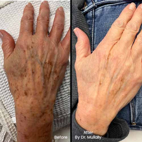 Age Spots Brown or Red Spots (Lumecca Treatment) in Crown Point IN