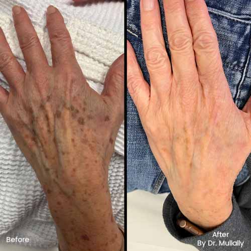 Age Spots Brown or Red Spots (Lumecca Treatment) in Crown Point IN Age Spots Brown or Red Spots (Lumecca Treatment) in Crown Point IN