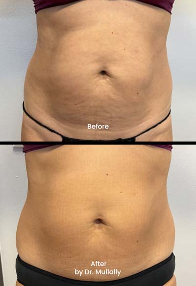 Evolve Skin Tightening Treatment in Crown Point IN