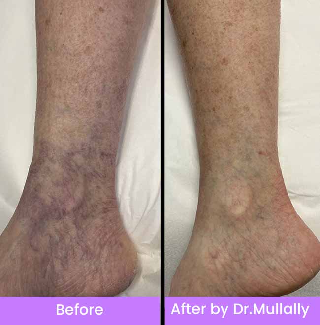 Spider Vein (Vasculaze Treatment) in Crown Point IN