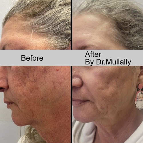 Age Spots Brown or Red Spots (Lumecca Treatment) in Crown Point IN