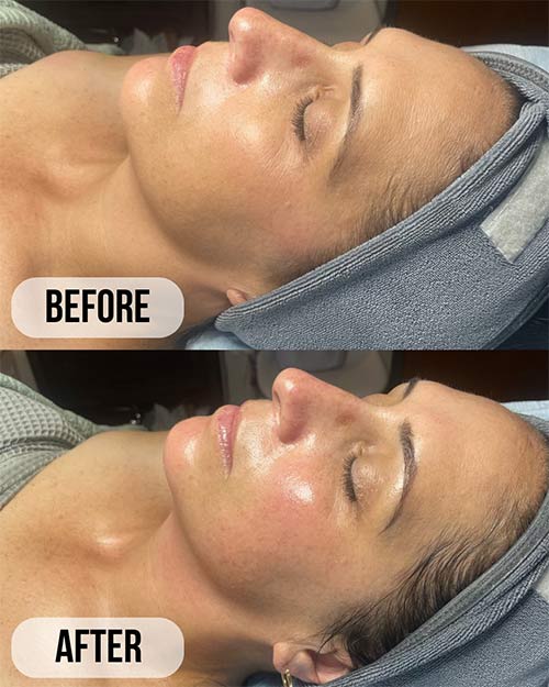 Facial Contouring Treatment Specialist Near Me in Crown Point IN Facial Contouring Treatment Specialist Near Me in Crown Point IN